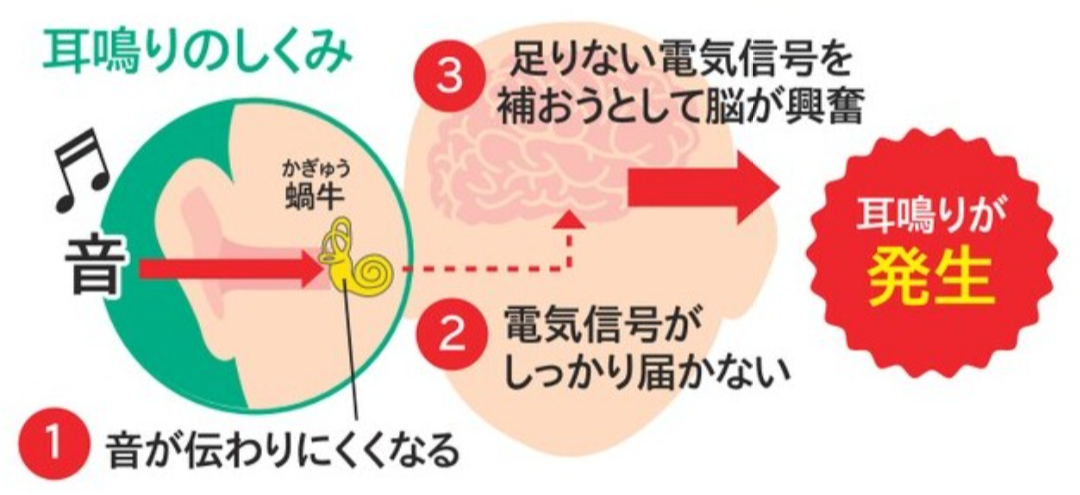 耳鳴りの仕組み.png