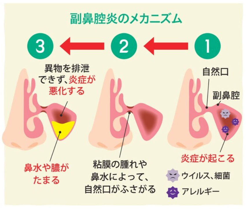 副鼻腔炎のメカニズム.png